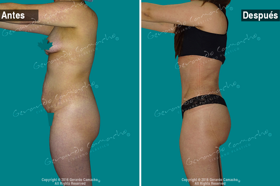 Paciente feliz con resultados de abdominoplastia en Bogotá